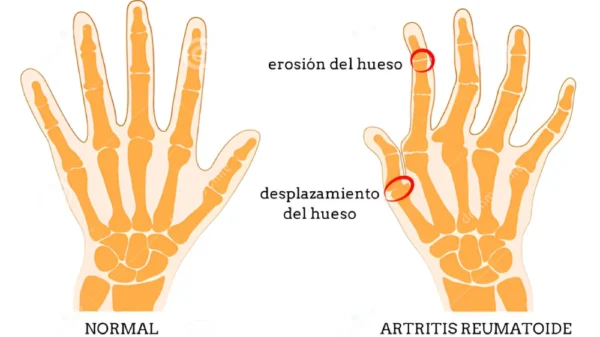 Come para aliviar: alimentos que calman la artritis