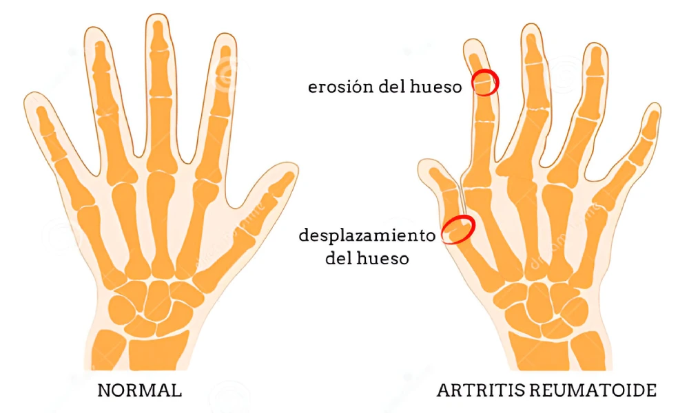 Come para aliviar: alimentos que calman la artritis