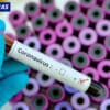 Áncash: Descartan COVID-19 en 103 muestras
