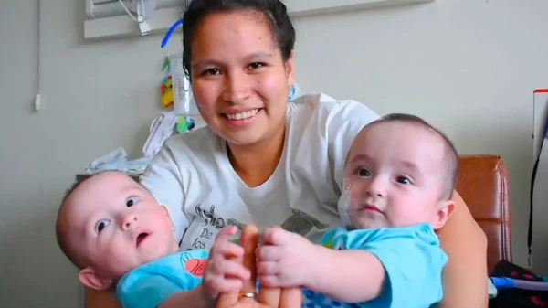 Siameses peruanos tras exitosa operación cumplirán 5 años.