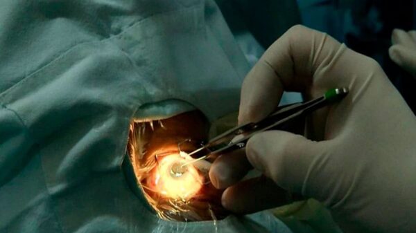 Hospital Arzobispo Loayza realiza trasplante de córnea