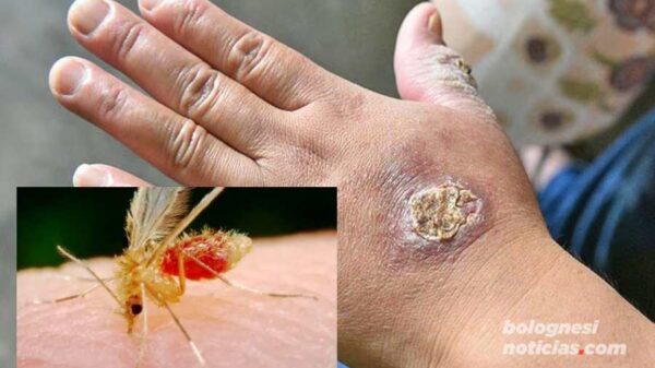 Leishmaniosis cutánea reporta 36 casos en Pallasca, Áncash, Perú.