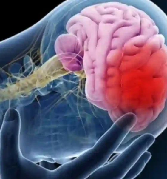 Ataque cerebrovascular: causas, consecuencias y cómo actuar