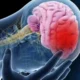 Ataque cerebrovascular: causas, consecuencias y cómo actuar